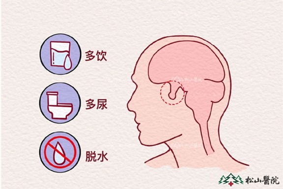 中樞性尿崩癥。重慶松山醫(yī)院供圖