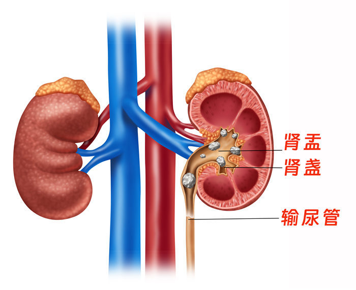 多發(fā)結(jié)石示意圖